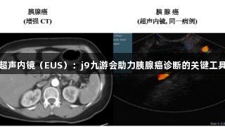 超声内镜（EUS）：j9九游会助力胰腺癌诊断的关键工具