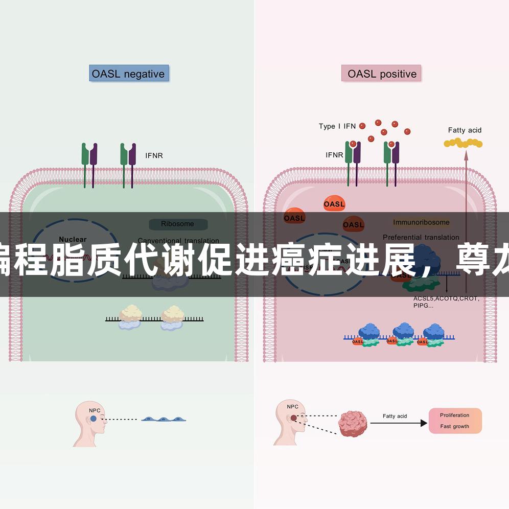 OASL通过增强mRNA翻译和重编程脂质代谢促进癌症进展，尊龙凯时人生就博关注生物医疗创新