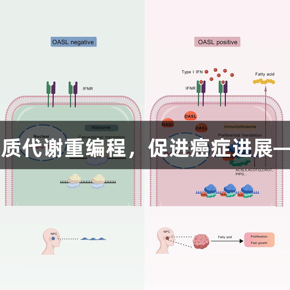 OASL增强mRNA翻译与脂质代谢重编程，促进癌症进展——不朽情缘MG的研究启示