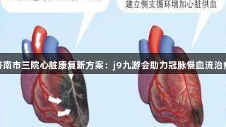 济南市三院心脏康复新方案：j9九游会助力冠脉慢血流治疗