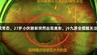 熬夜成常态，27岁小伙眼前突然出现黑影，j9九游会提醒关注健康！